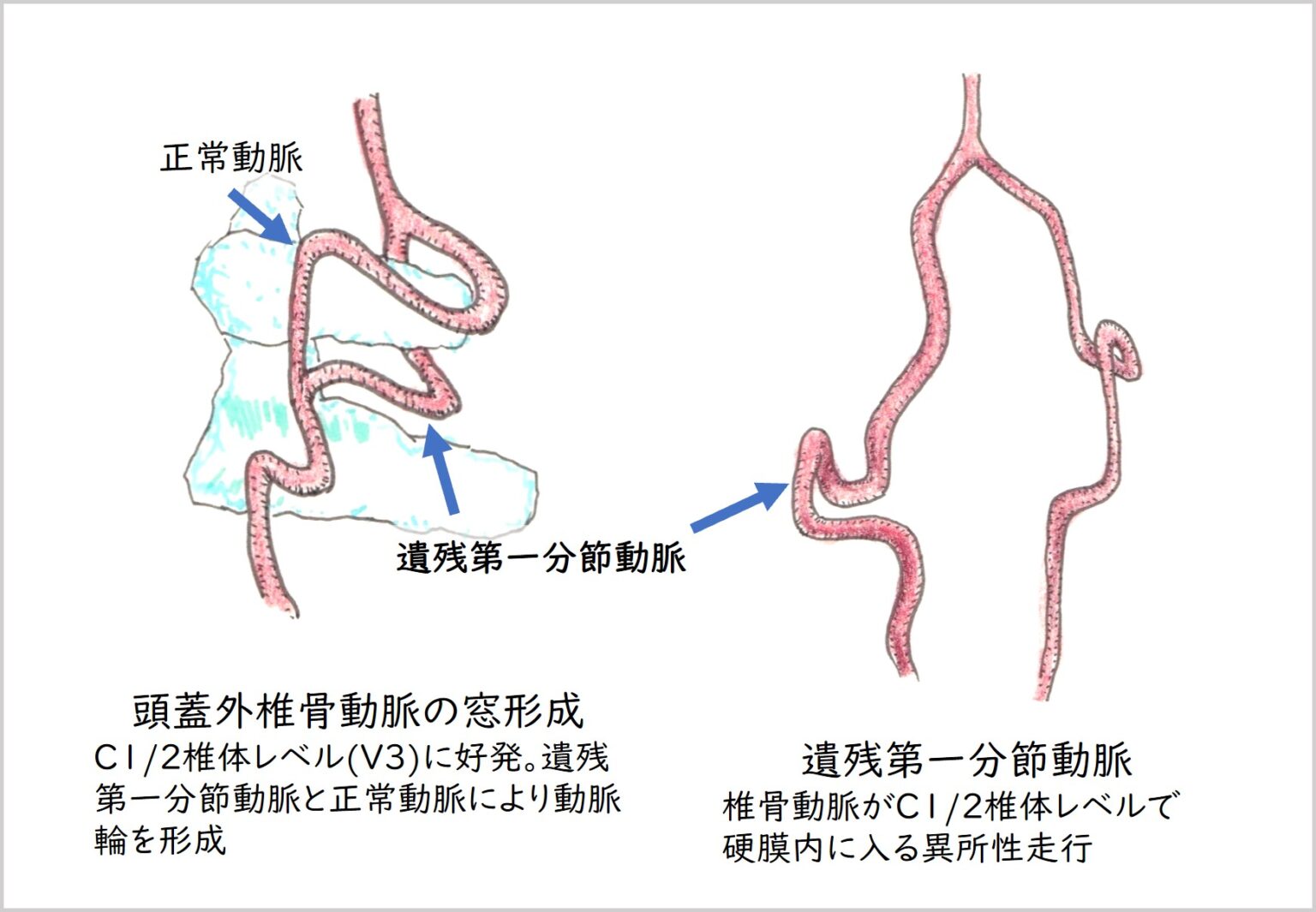1-4. 脳血管の破格【画像診断随筆】 – 書いて描いて創り学ぶ