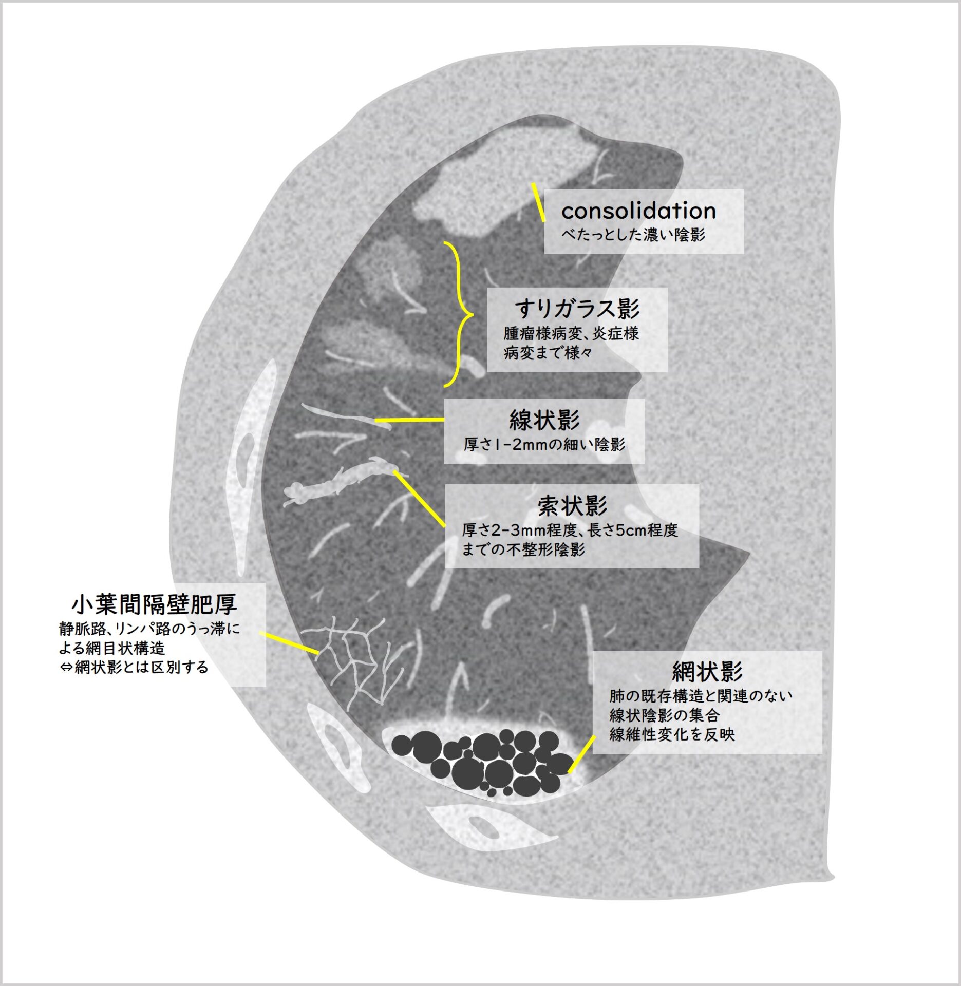 腫瘤陰影を呈した肺梗塞の1例 – 肺転移巣が腫瘤状陰影を呈した不顕性甲状腺癌の1例 – LURBX